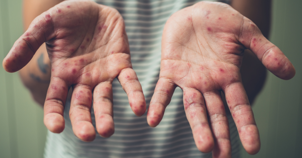 Atopic dermatitis hands